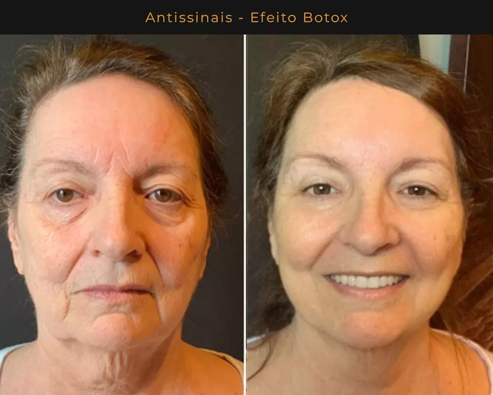 Antes e depois 1