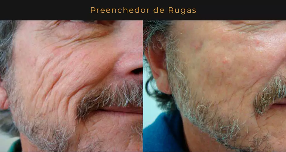Antes e depois 2